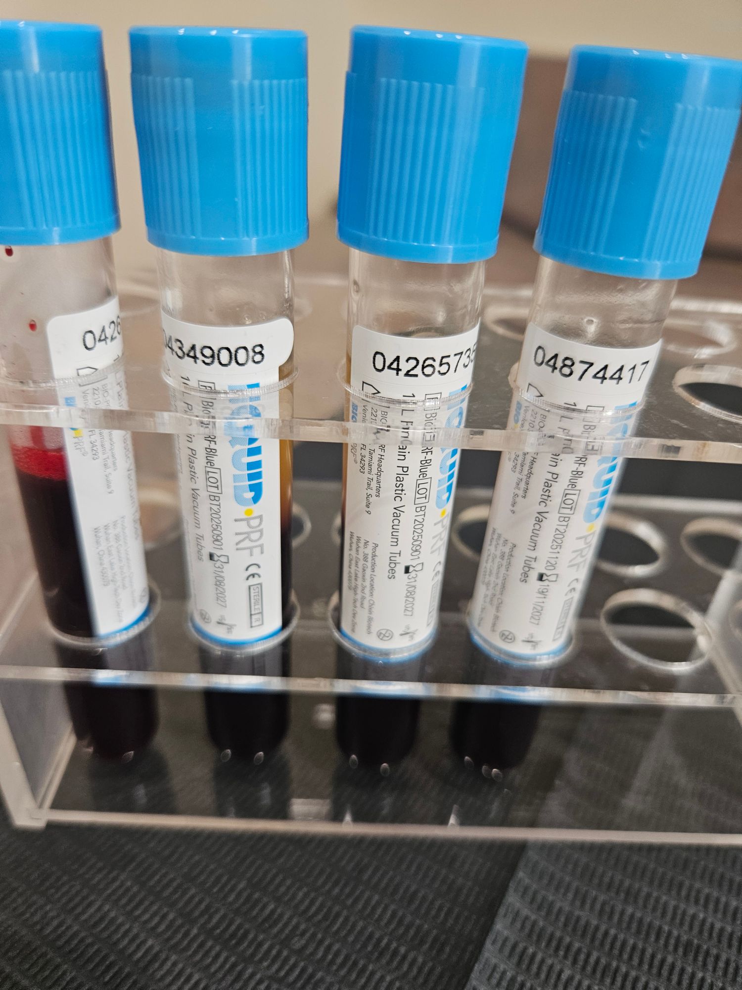 PRP vs. Cortisone for Knee Arthritis: Which Supports Longer-Term Improvement?