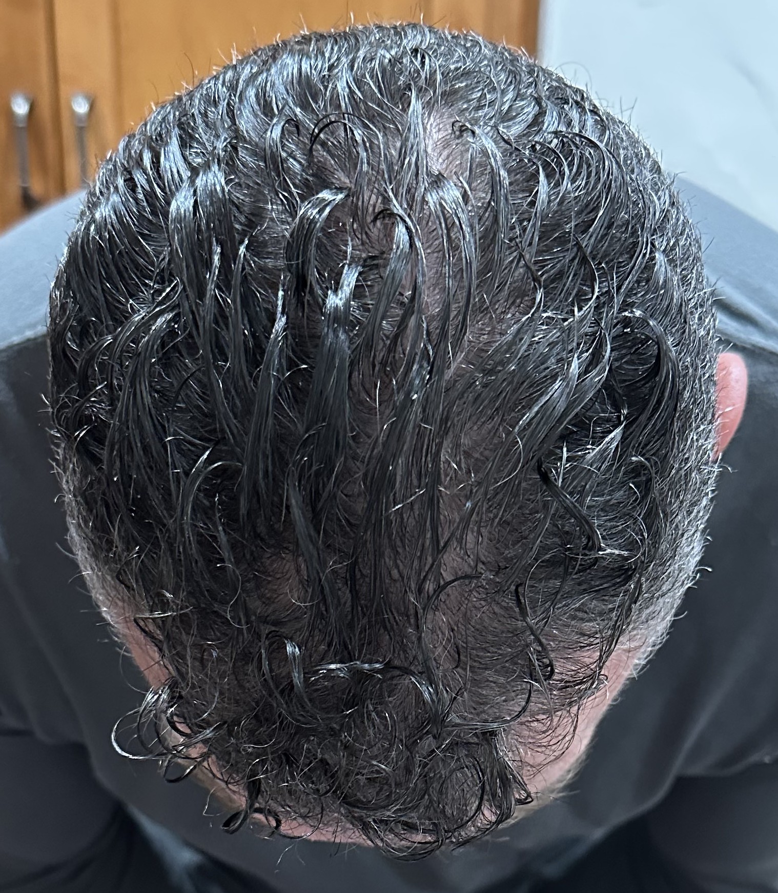 After PRP and iPRF hair restoration treatment showing improved crown density